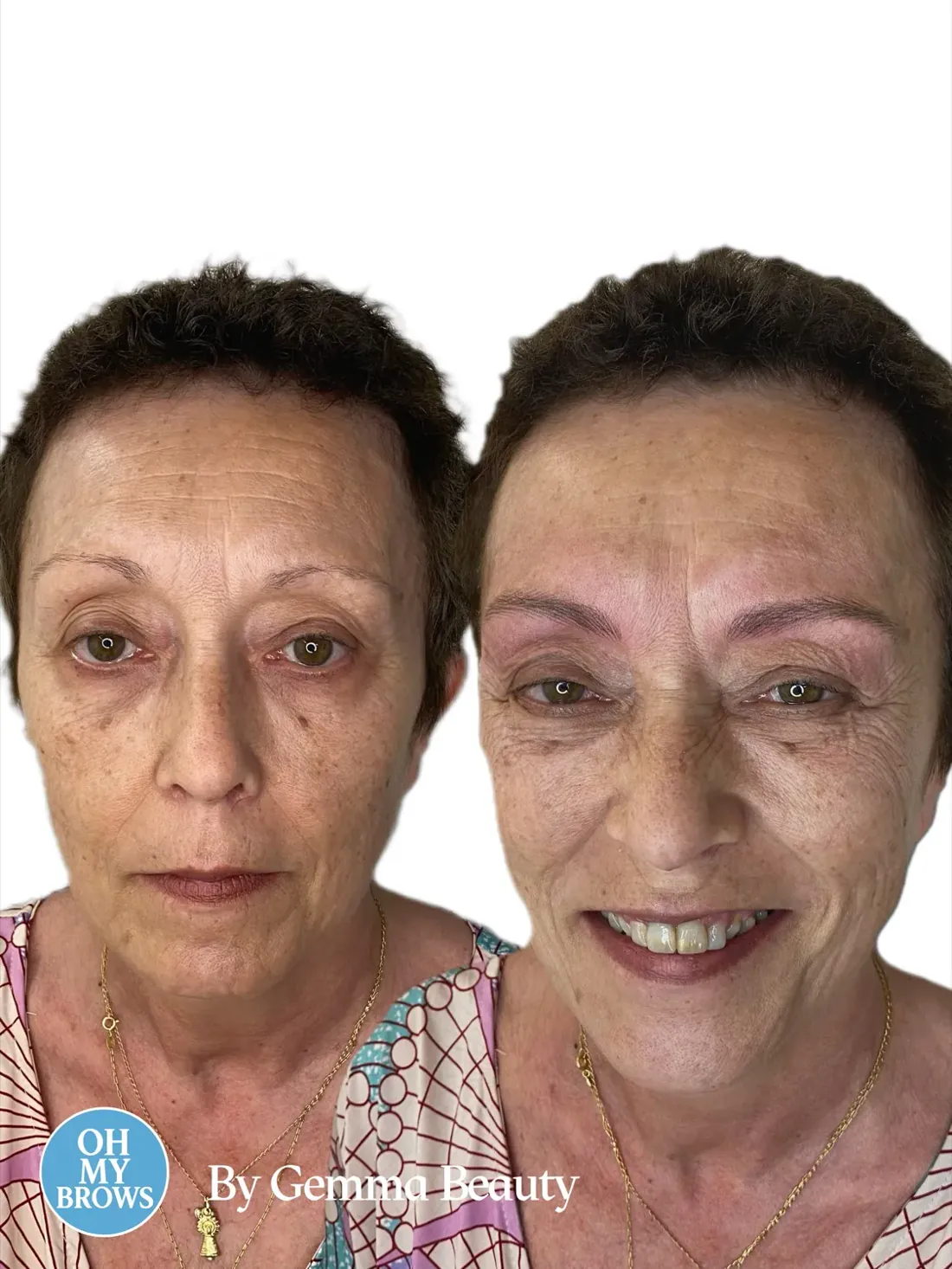 Cejas recreadas pelo a pelo en un caso sin vello previo